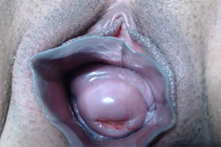 prolapse_uretra